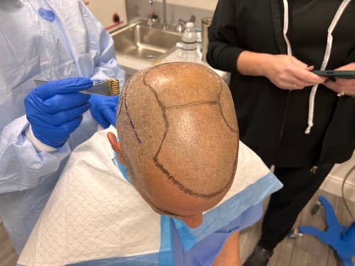 Procedure day: the transplant area mapped out
