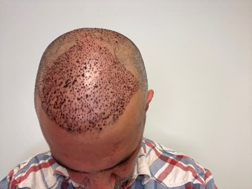 The day after: freshly placed grafts