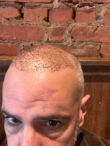 Five days in: the new hairline healing